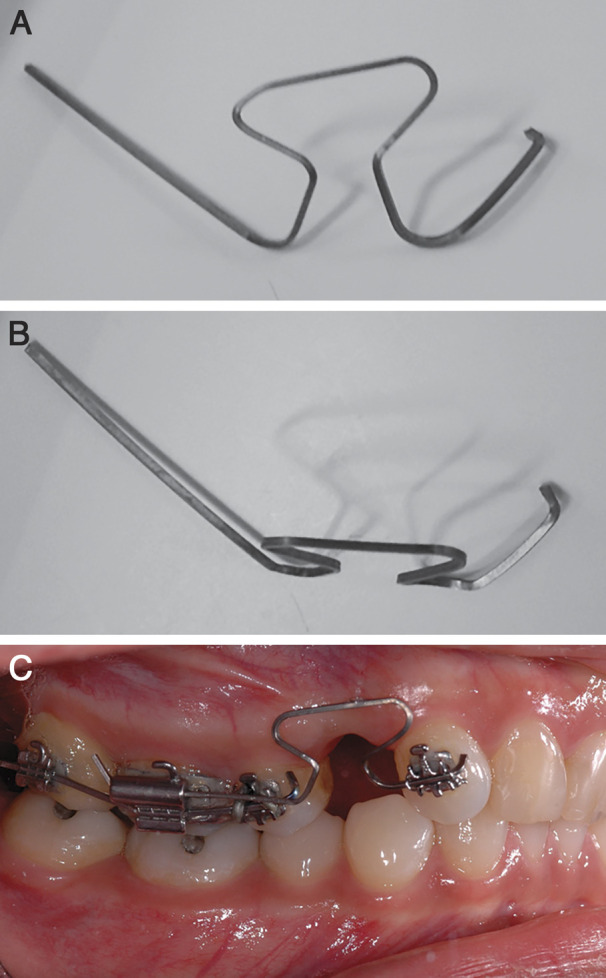 Figure 1. (A) T-loop side view. (B) T-loop top view. (C) T-loop side intraoral view.