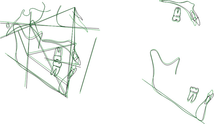 Figure 2. Cephalometric tracing superimposition of a case treated with segmented arch mechanics.