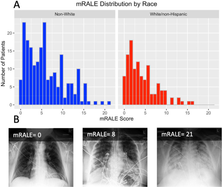 Title: Histogram of mRALE Score Distribution by Race. A) Distribution of mRALE categories on Admission Chest Radiograph by Race/Ethnicity. Non-White/Hispanic patients were more likely to have higher mRALE score categories compared with White/non-Hispanic patients (Coefficient 0.560, 95% CI 0.046 to 1.074 to, p = 0.033). On average, adjusted for potential confounders, Non-White patients presented with higher mRALE scores on admission CXR compared with White patients (average difference 1.60, 95%CI 0.50 to 2.71, p=0.005) in our multiple variable linear regression analyses (B) Examples of modified Radiograph Assessment of Lung Edema (mRALE) annotations for pulmonary disease severity in patients with COVID-19. The top left inset number for each image is the corresponding mRALE score, the average of annotations by multiple raters. A score of 0-4 was categorized as mild, 4.1-10 was moderate, and >10 was severe.