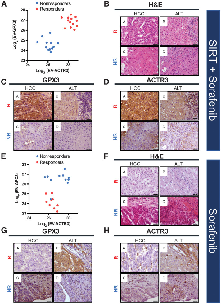 Figure 5. Levels of EV-GPX3 and EV-ACTR3 and corresponding protein expression in HCC and ALT prior to SIRT+sorafenib treatment (A–D) and sorafenib treatment (E–H) in responders (R) and nonresponders (NR). A, Correlation analysis of EV-GPX3 and EV-ACTR3 showing distinct clusters of responders and nonresponders in the SIRT+sorafenib treatment group. B, Representative images of hematoxylin and eosin (H&E) staining of HCC tissue and ALT prior to SIRT+sorafenib treatment. C, IHC staining of GPX3 in HCC tissue and ALT prior to SIRT+sorafenib treatment. D, IHC staining of ACTR3 in HCC tissue and ALT prior to SIRT+sorafenib treatment. E, Correlation analysis of EV-GPX3 and EV-ACTR3 in sorafenib treatment group. F, Representative images of H&E staining of HCC tissue and ALT prior to sorafenib treatment. G, IHC staining of GPX3 in HCC tissue and ALT prior to sorafenib treatment. H, IHC staining of ACTR3 in HCC tissue and ALT prior to sorafenib treatment. Magnification: 400×; scale bar: 50 μm.