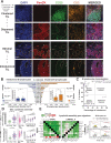 Figure 3. Occurrence of B lymphocytes in stromal clusters. A, Representative IHC/IF images (Bart's IHC cohort) highlighting key TIL characteristics: clustered TIL versus dispersed TIL and stromal TIL (outside tumor nests) versus intratumoral TIL (within tumor nests). Scale bar, 50 μm. B, Quantitative assessment of TIL-B spatial and structural characteristics within TNBC (N = 15; left) intratumoral versus stromal; clustered versus dispersed (right). Patients ranked according to CD20+ TIL-B density (TNBC1 = highest), and overall survival data are indicated. Inset, patient samples split at median density into high and low TIL-B groups and the percentage of intratumoral (left) or clustered (right) B lymphocytes were analyzed. Statistical significance was determined using the Student t test. C, Characterization of TNBC TIL-B profile as stromal clustered, intratumoral clustered, stromal dispersed, or intratumoral dispersed. Overall survival data are indicated. D, GEx data for lymphoid assembly marker genes CXCL13 and DC-LAMP: normal breast versus TNBC (N = 10 vs. 131, KCL GEx cohort; left); non-TNBC vs. TNBC (N = 515 vs. 123, TCGA GEx cohort; middle); TNBC subtypes (N = 122, KCL GEx cohort; right). E, Survival analysis in KM Plotter of determined ER−HER2−/basal surrogate, HER2+, luminal A, and luminal B subtype KM plotter surrogate subgroups (KM plotter cohort; ref. 19). These indicate that expression of lymphoid cell assembly genes carries positive prognostic value in TNBC/basal-like and luminal B subtypes. Individual genes were evaluated in combination with each other gene (left) and gene set as a whole (right). ns, nonsignificant; *, P < 0.05; **, P < 0.01; ****, P < 0.0001.