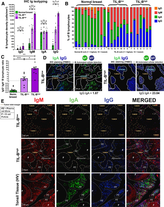 Figure 5. Quantitative fluorescence IHC reveals elevated IgG+:IgA+ ratio within high TIL-B tumors, implicating expansion of IgG+ B lymphocytes within TNBC tumor microenvironment. A, Comparison of surface immunoglobulin-expressing B lymphocyte density in normal breast and TNBC with low TIL-B density (below median CD20+) and high TIL-B density (above median CD20+). B, Quantitative IHC analysis profiling the proportions of B lymphocytes present within the microenvironment of normal breast tissue (N = 10) and TNBC (N = 14) expressing each Ig isotype. C, Enumeration of IgG+:IgA+ B lymphocyte ratios. D, Right, example images illustrating IgG+ and IgA+ B lymphocytes in a typical TIL-B low individual and a TIL-B high individual. Automated cellular detection identifies IgA (green) and IgG (blue) B lymphocytes. Scale bar, 100 μm. E, Representative images depicting typical Ig isotype expression among B lymphocytes: IgM+ (red), IgA+ (green), and IgG+ (blue). Images from Bart's IHC cohort. Brown dash lines indicate margin of the cancer. White lines separate distinct regions of B lymphocyte compartments (PZ, plasma cell zone; F, B lymphocyte follicle). Scale bar, 100 μm. Statistical significance was determined using the Student t-test. ns, nonsignificant; *, P < 0.05; **, P < 0.01; ***, P < 0.001.