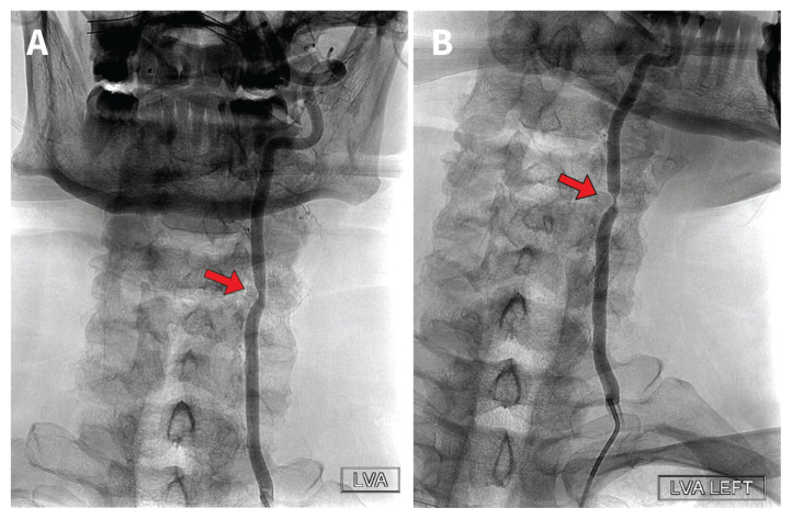 Bow hunter syndrome - PMC