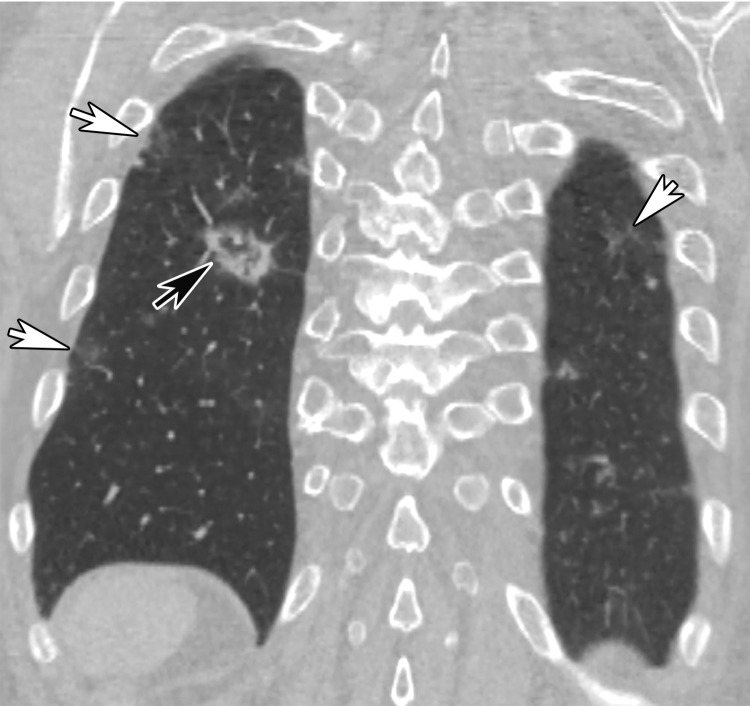 Reverse halo sign in a 76-year-old man with COVID-19 and a history of pancreatic cancer. (a, b) Axial (a) and coronal (b) contrast-enhanced CT images show a nodular opacity (black arrow) in the right lower lobe, with central GGOs and peripheral solid consolidation, consistent with a reverse halo sign. Note the subtle bilateral peripheral GGOs (white arrows). (c) Axial contrast-enhanced CT image obtained 3 weeks after diagnosis shows subsequent resolution of the reverse halo sign, with vague residual opacity (circle).