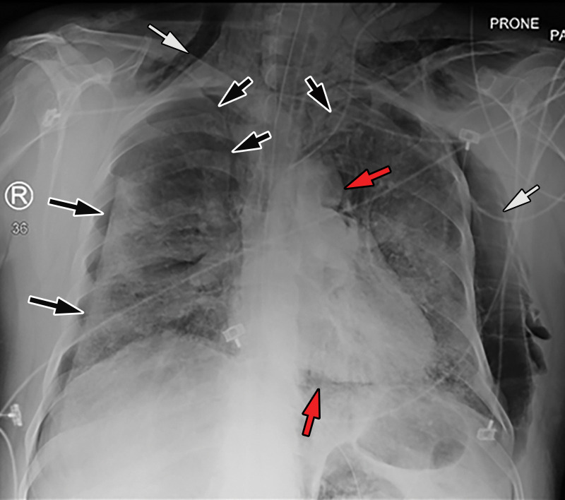 COVID-19 complicated by pneumothorax and pneumomediastinum in a 59-year-old man who underwent intubation with increased oxygen requirements. Posteroranterior chest radiograph obtained in the prone position shows moderate-size right pneumothorax and small left apical pneumothorax (black arrows). Pneumomediastinum is evident by the presence of air around the aortic arch and beneath the heart (red arrows). The endotracheal tube and feeding tube are in place. A large amount of subcutaneous emphysema is depicted bilaterally (white arrows). The patchy bilateral hazy opacities are compatible with COVID-19 pneumonia.