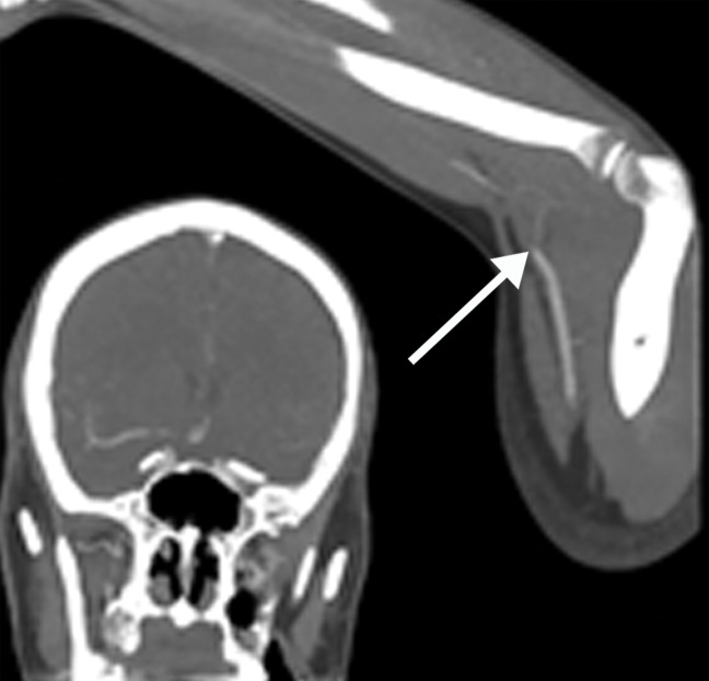 Brachial artery thrombosis and renal infarct in a 51-year-old man who presented to the emergency department with acute left upper extremity pain and numbness. The patient had a 2-week history of cough and fever and was confirmed to be COVID-19 positive. (a) Coronal left upper extremity CT angiographic image shows an abrupt segmental occlusion (arrow) of the distal left brachial artery, indicative of peripheral arterial thromboembolization. The left subclavian and axillary arteries were otherwise unremarkable, with good opacification of the arteries. (b) Coronal three-dimensional maximum intensity projection shows abrupt cutoff (arrow) of the left brachial artery. (c, d) Axial chest CT angiographic images show the typical appearance of lung changes in COVID-19 pneumonia (arrows in c). Note the incidentally found sharp well-defined area of nonenhancement in the partially imaged upper pole of the right kidney, a finding indicative of a renal infarct (arrows in d).