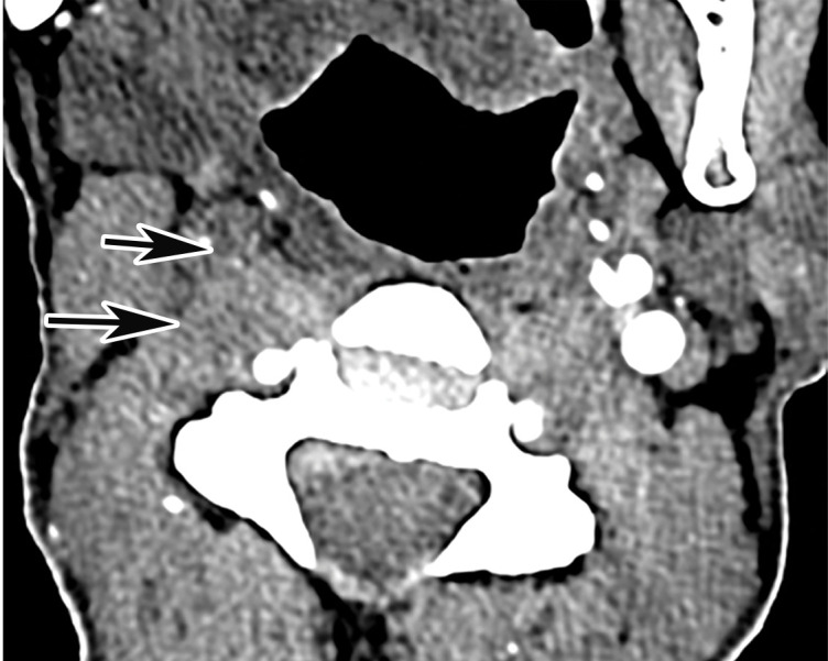 Common carotid artery (CCA) occlusion in a 56-year-old woman with neurologic deficits who had been hospitalized with COVID-19. (a, b) Coronal three-dimensional maximum intensity projection reformatted image (a) and axial CT angiographic image (b) of the head and neck show an abrupt cutoff at the origin of the CCA (black arrow in a). Note the absence of opacification of the right CCA, as well as internal and external carotid arteries (arrows in b). The left carotid vasculature is well opacified with intravenous contrast material (white arrow in a). (c) Axial nonenhanced head CT image shows wedge-shaped areas of hypoattenuation (arrows) in a watershed distribution, consistent with acute infarcts related to carotid occlusion.