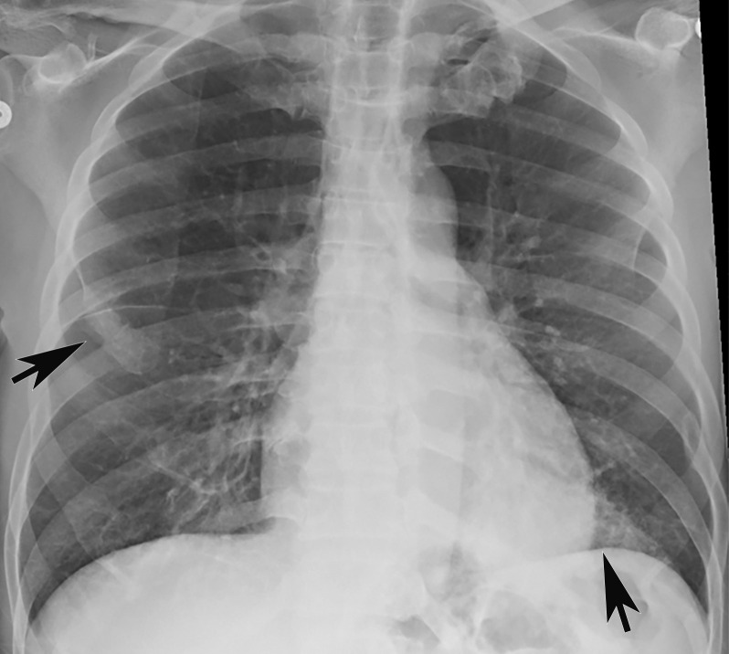 Longitudinal assessment of COVID-19 pneumonia progression in a 56-year-old man who presented to the emergency department with dyspnea and dry cough. (a) AP chest radiograph obtained at hospital admission at the time of symptom onset shows bilateral pulmonary opacities (arrows) at the periphery of the right mid lung and at the left lung base. (b) AP chest radiograph obtained on day 8 of hospitalization shows progression of multifocal opacities bilaterally, which now involve more than two lobes, and interval development of bibasilar consolidations. These findings correspond to a higher severity score and carry a worse prognosis. In addition, there is mild pulmonary edema, suggestive of fluid overload. Note that the patient had undergone intubation. (c) AP chest radiograph obtained on day 14 of hospitalization shows progression of the multifocal bilateral peripheral opacities.