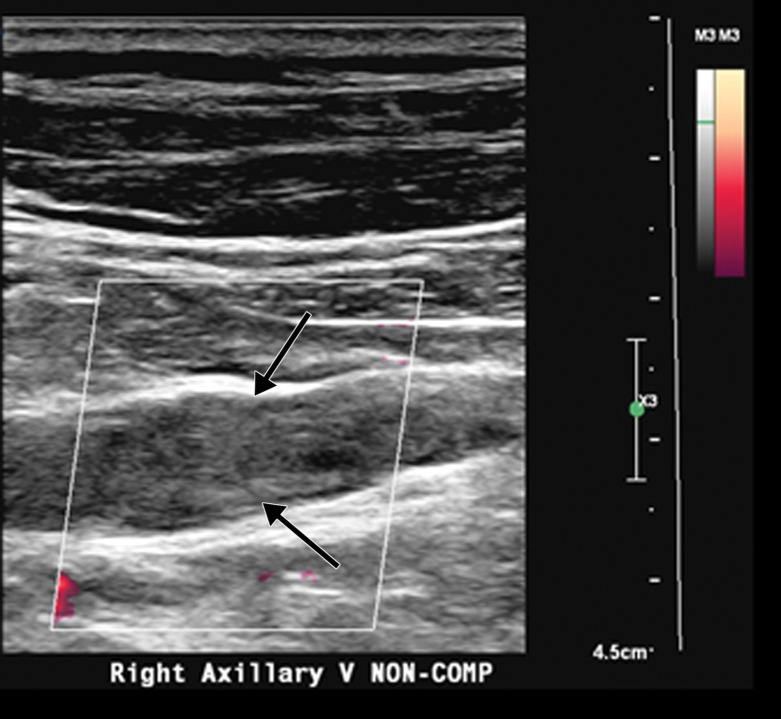 Extensive bilateral upper extremity DVT in a critically ill 77-year-old man with COVID-19 who developed bilateral upper extremity swelling, with markedly elevated d-dimer levels (31 447 ng/mL). (a, b) Sagittal color (a) and power (b) Doppler US images show absent flow in the distended vein, with echogenic material in the left subclavian vein (arrow in a) and the right axillary vein (arrows in b), compatible with bilateral occlusive thrombi. Additional occlusive and nonocclusive thrombi were also seen (not shown). (c) Gray-scale US images without (left) and with (right) compression show a thrombus (arrows) in the right cephalic vein, which demonstrates no vascular compression (arrows).