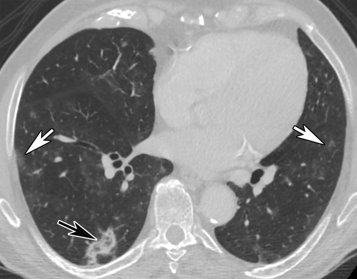 Reverse halo sign in a 76-year-old man with COVID-19 and a history of pancreatic cancer. (a, b) Axial (a) and coronal (b) contrast-enhanced CT images show a nodular opacity (black arrow) in the right lower lobe, with central GGOs and peripheral solid consolidation, consistent with a reverse halo sign. Note the subtle bilateral peripheral GGOs (white arrows). (c) Axial contrast-enhanced CT image obtained 3 weeks after diagnosis shows subsequent resolution of the reverse halo sign, with vague residual opacity (circle).