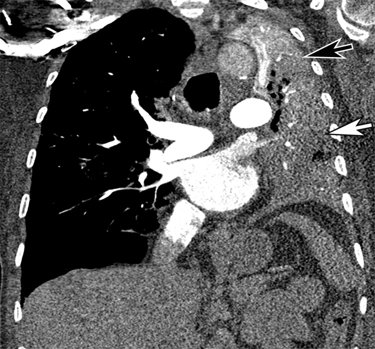 COVID-19 pneumonia complicated by mucus plugging and lung collapse in a 78-year-old man who presented with shortness of breath and suspicion of PE. Axial (a) and coronal (b, c) chest CT angiographic images show patchy GGOs (arrowheads in b) on the right and left lung opacification with volume loss in the left upper lobe due to atelectasis. Adjacent atelectasis and pneumonia in the left upper and lower lobes are evidenced by enhancement of the atelectatic lung (black arrow in c) and absence of enhancement within the pneumonic consolidation (white arrow in c). Atelectasis was caused by the presence of thick mucus that resulted in bronchial obstruction and subsequent collapse.