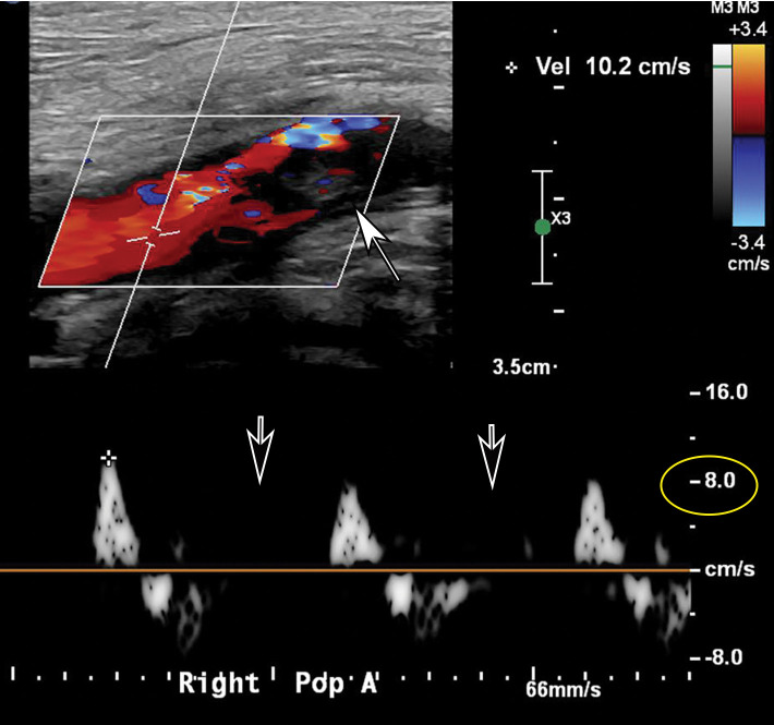 Popliteal and posterior tibial artery thrombosis in a 58-year-old woman with COVID-19 in the ICU. (a, b) Sagittal color (a) and spectral (b) Doppler US images show an echogenic heterogeneous thrombus (white arrows) distending the right popliteal artery. The characteristic knocking or “stump-thump” waveform with absence of diastolic flow (black arrows in b) and low amplitude (yellow circle in b) imply the presence of occlusion just distal to the area of interrogation. (c) Sagittal power Doppler US image shows no flow in the occluded right posterior tibial artery (black arrows). (d) Corresponding sagittal CT angiographic reconstruction shows abrupt cutoff of the popliteal artery by a thrombus (solid arrow). Note the opacified popliteal artery (Rt POP A) proximal to the thrombus (dashed arrow). The patient also had a liver infarct and bowel ischemia (not shown).