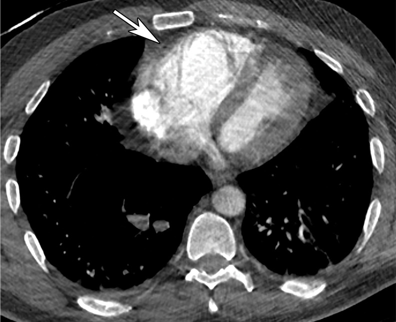 Saddle embolus in a 52-year-old man who presented to the emergency department with hypoxia and tachycardia and received positive test results for COVID-19. (a–c) Axial chest CT angiographic images show a saddle embolus (arrows in a), extending into the lobar and segmental pulmonary artery branches bilaterally, and associated dilatation of the right ventricle, suggestive of right heart strain (arrow in b). Patchy peripheral GGOs on the right and a nodular area of consolidation (arrows in c) on the left are typical findings of COVID-19 pneumonia. (d) Gray-scale (left) and corresponding color Doppler (right) US images of the left femoral vein (FV) obtained in the transverse plane show a partially occlusive thrombus (arrows). The vein was not compressible at manual compression (not shown).