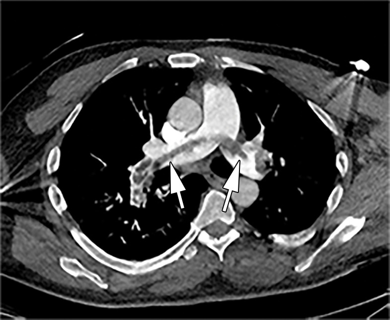 Saddle embolus in a 52-year-old man who presented to the emergency department with hypoxia and tachycardia and received positive test results for COVID-19. (a–c) Axial chest CT angiographic images show a saddle embolus (arrows in a), extending into the lobar and segmental pulmonary artery branches bilaterally, and associated dilatation of the right ventricle, suggestive of right heart strain (arrow in b). Patchy peripheral GGOs on the right and a nodular area of consolidation (arrows in c) on the left are typical findings of COVID-19 pneumonia. (d) Gray-scale (left) and corresponding color Doppler (right) US images of the left femoral vein (FV) obtained in the transverse plane show a partially occlusive thrombus (arrows). The vein was not compressible at manual compression (not shown).