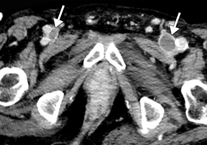 Inferior vena cava (IVC) and peripheral deep vein thrombosis in a 78-year-old man with COVID-19 with leg swelling and abdominal pain. Sagittal (a) and axial (b) contrast-enhanced CT images show filling defects in the bilateral common femoral veins (solid arrows). Near complete occlusion of the IVC (solid arrows in a) to the level of an IVC filter (dashed arrow in a) was present. Note the renal transplant (arrowhead in a). Both central and peripheral venous thrombosis were not depicted at prior imaging examinations (not shown).