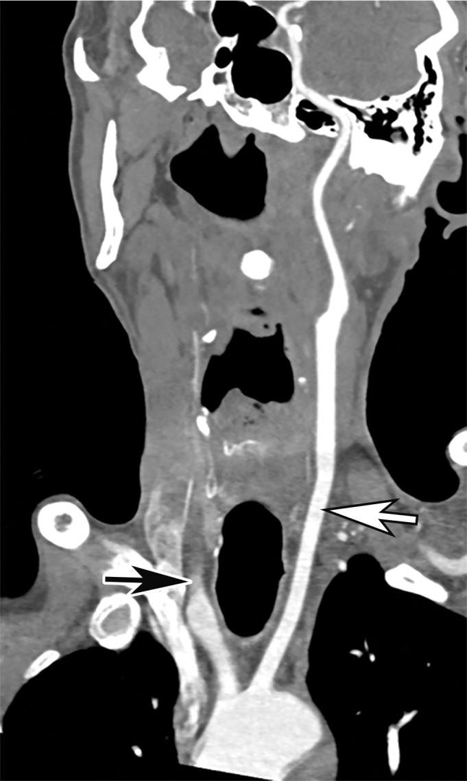 Common carotid artery (CCA) occlusion in a 56-year-old woman with neurologic deficits who had been hospitalized with COVID-19. (a, b) Coronal three-dimensional maximum intensity projection reformatted image (a) and axial CT angiographic image (b) of the head and neck show an abrupt cutoff at the origin of the CCA (black arrow in a). Note the absence of opacification of the right CCA, as well as internal and external carotid arteries (arrows in b). The left carotid vasculature is well opacified with intravenous contrast material (white arrow in a). (c) Axial nonenhanced head CT image shows wedge-shaped areas of hypoattenuation (arrows) in a watershed distribution, consistent with acute infarcts related to carotid occlusion.