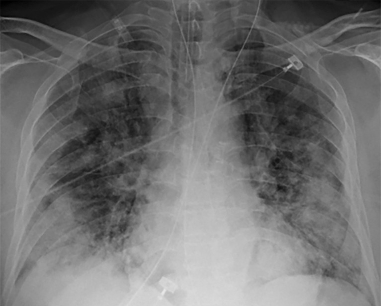 Longitudinal assessment of COVID-19 pneumonia progression in a 56-year-old man who presented to the emergency department with dyspnea and dry cough. (a) AP chest radiograph obtained at hospital admission at the time of symptom onset shows bilateral pulmonary opacities (arrows) at the periphery of the right mid lung and at the left lung base. (b) AP chest radiograph obtained on day 8 of hospitalization shows progression of multifocal opacities bilaterally, which now involve more than two lobes, and interval development of bibasilar consolidations. These findings correspond to a higher severity score and carry a worse prognosis. In addition, there is mild pulmonary edema, suggestive of fluid overload. Note that the patient had undergone intubation. (c) AP chest radiograph obtained on day 14 of hospitalization shows progression of the multifocal bilateral peripheral opacities.