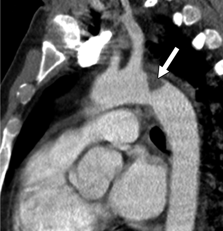 Central and peripheral arterial thrombosis in a severely ill 46-year-old man with COVID-19 in the ICU. (a, b) Axial (a) and sagittal (b) chest CT angiographic images show bibasilar areas of consolidation (black arrows in a), indicative of COVID-19 pneumonia, and a central aortic thrombosis with a thrombus attached to the wall of the aortic arch (white arrow in a and b). (c–f) Sagittal (c), coronal (d), and axial (e, f) CT angiographic images show a large thrombus extending from the abdominal aorta into the superior mesenteric artery origin (arrow in c), which resulted in bowel ischemia, evidenced by thickening of the watershed splenic flexure of the large bowel (arrow in d). Note the multifocal bilateral wedge-shaped renal cortical infarcts (arrows in e). Note also a nonocclusive thrombus in the left profunda femoris artery (white arrow in f), indicative of a concurrent presence of a peripheral thrombosis. There is normal opacification of the patent right profunda femoris artery (black arrow in f). This case demonstrates multifocal multisystem manifestations of COVID-19 complicated by coagulopathy that resulted in injury to various organs and systems. It is an example of the need for increased awareness among radiologists to thoroughly evaluate all covered anatomy for COVID-related complications.