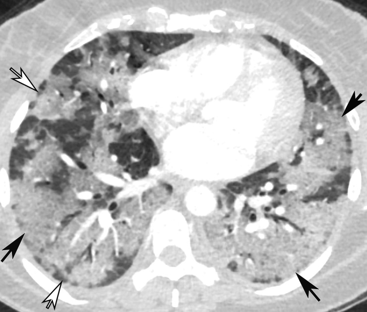 Temporal pulmonary changes of COVID-19 pneumonia at CT in a 36-year-old woman. (a–c) Axial contrast-enhanced CT images obtained at hospital admission show patchy bilateral GGOs and interlobular septal thickening (black arrows), with lower lobe predominance and subpleural involvement. Note also some immediate subpleural sparing of the GGOs (white arrows in b and c). (d–f) Follow-up corresponding axial contrast-enhanced CT images show evolving consolidative changes with volume loss, architectural distortion (ovals), and bronchiectasis (arrows in e and f).