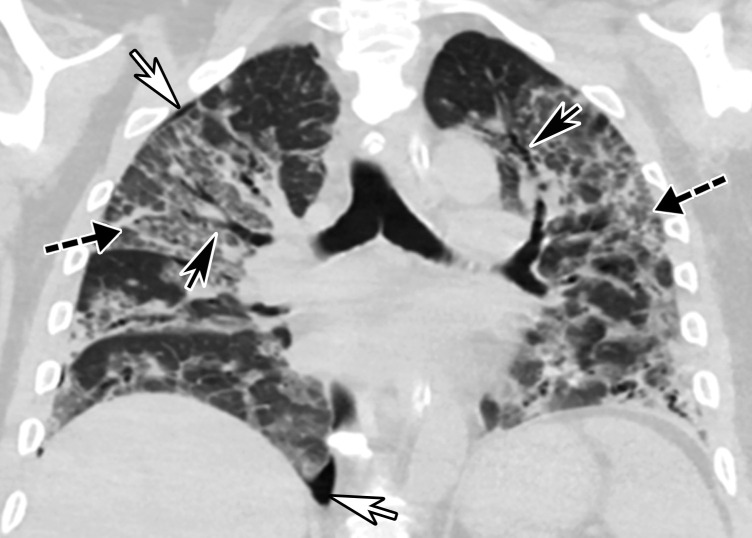 Time course of lung changes in a 59-year-old man with COVID-19 pneumonia evaluated at chest radiography and CT over a 2-month period, which was complicated by development of a pneumothorax. (a–c) AP chest radiographs obtained at hospital admission (a), 4 days later (b), and 1 month later (c) show a peripheral patchy opacity in the left mid lung (oval in a) at the initial assessment, with substantial progression of lung disease on day 4 (b), with development of multiple bilateral peripheral areas of consolidation. The radiograph obtained 1 month later (c) shows interval improvement of the bilateral areas of consolidation and an increase in reticular opacities (dashed arrows in c), with the development of bronchial dilatation (solid arrow in c). Note that at this time the patient had undergone tracheostomy. (d, e) Axial (d) and coronal (e) contrast-enhanced chest CT images, obtained at the same time as c for worsening shortness of breath, show diffuse GGOs associated with superimposed interlobular reticulations, resulting in a crazy-paving pattern (dashed black arrows) and bronchial dilatation (black solid arrows in e). The findings were complicated by the presence of a moderate-sized anterior pneumothorax (white arrows), which was not well appreciated on the plain radiograph (c).