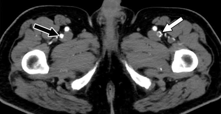 Central and peripheral arterial thrombosis in a severely ill 46-year-old man with COVID-19 in the ICU. (a, b) Axial (a) and sagittal (b) chest CT angiographic images show bibasilar areas of consolidation (black arrows in a), indicative of COVID-19 pneumonia, and a central aortic thrombosis with a thrombus attached to the wall of the aortic arch (white arrow in a and b). (c–f) Sagittal (c), coronal (d), and axial (e, f) CT angiographic images show a large thrombus extending from the abdominal aorta into the superior mesenteric artery origin (arrow in c), which resulted in bowel ischemia, evidenced by thickening of the watershed splenic flexure of the large bowel (arrow in d). Note the multifocal bilateral wedge-shaped renal cortical infarcts (arrows in e). Note also a nonocclusive thrombus in the left profunda femoris artery (white arrow in f), indicative of a concurrent presence of a peripheral thrombosis. There is normal opacification of the patent right profunda femoris artery (black arrow in f). This case demonstrates multifocal multisystem manifestations of COVID-19 complicated by coagulopathy that resulted in injury to various organs and systems. It is an example of the need for increased awareness among radiologists to thoroughly evaluate all covered anatomy for COVID-related complications.