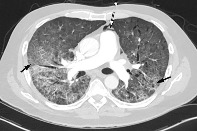 COVID-19 complicated by pneumomediastinum in a 61-year-old man. Axial (a) and coronal (b) chest CT angiographic images show a typical appearance of COVID-19 pneumonia, including diffuse GGOs and interlobular septal thickening (black arrows). Air is depicted anterior to the pulmonary artery (white arrow in a) and adjacent to the main pulmonary artery and left atrial appendage (white arrow in b), indicative of pneumomediastinum.