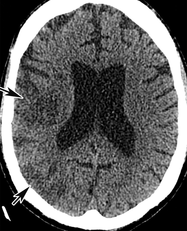 Common carotid artery (CCA) occlusion in a 56-year-old woman with neurologic deficits who had been hospitalized with COVID-19. (a, b) Coronal three-dimensional maximum intensity projection reformatted image (a) and axial CT angiographic image (b) of the head and neck show an abrupt cutoff at the origin of the CCA (black arrow in a). Note the absence of opacification of the right CCA, as well as internal and external carotid arteries (arrows in b). The left carotid vasculature is well opacified with intravenous contrast material (white arrow in a). (c) Axial nonenhanced head CT image shows wedge-shaped areas of hypoattenuation (arrows) in a watershed distribution, consistent with acute infarcts related to carotid occlusion.