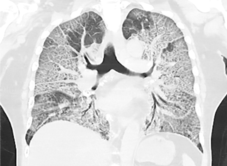 COVID-19 pneumonia with superimposed ARDS in a 61-year-old man who presented to the emergency department with hypoxia and subsequently underwent intubation. (a) AP chest radiograph shows bilateral diffuse lower-lobe predominant opacities (arrows), compatible with COVID pneumonia. (b) Coronal nonenhanced chest CT image shows “crazy-paving” pattern, with diffuse bilateral GGOs, interlobular septal thickening, and intralobular lines, a typical appearance of COVID-19 pneumonia.