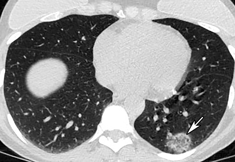 Focal unilateral opacity in a 52-year-old woman who presented with persistent cough and positive COVID-19 RT-PCR and immunoglobulin G antibody test results. Axial nonenhanced chest CT image shows a focal unilateral 3-cm rounded peripheral GGO (arrow).