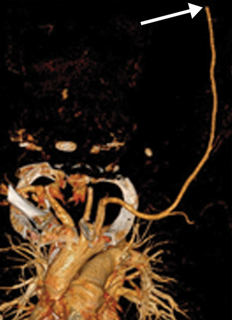 Brachial artery thrombosis and renal infarct in a 51-year-old man who presented to the emergency department with acute left upper extremity pain and numbness. The patient had a 2-week history of cough and fever and was confirmed to be COVID-19 positive. (a) Coronal left upper extremity CT angiographic image shows an abrupt segmental occlusion (arrow) of the distal left brachial artery, indicative of peripheral arterial thromboembolization. The left subclavian and axillary arteries were otherwise unremarkable, with good opacification of the arteries. (b) Coronal three-dimensional maximum intensity projection shows abrupt cutoff (arrow) of the left brachial artery. (c, d) Axial chest CT angiographic images show the typical appearance of lung changes in COVID-19 pneumonia (arrows in c). Note the incidentally found sharp well-defined area of nonenhancement in the partially imaged upper pole of the right kidney, a finding indicative of a renal infarct (arrows in d).