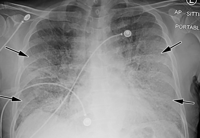 COVID-19 pneumonia with superimposed ARDS in a 61-year-old man who presented to the emergency department with hypoxia and subsequently underwent intubation. (a) AP chest radiograph shows bilateral diffuse lower-lobe predominant opacities (arrows), compatible with COVID pneumonia. (b) Coronal nonenhanced chest CT image shows “crazy-paving” pattern, with diffuse bilateral GGOs, interlobular septal thickening, and intralobular lines, a typical appearance of COVID-19 pneumonia.