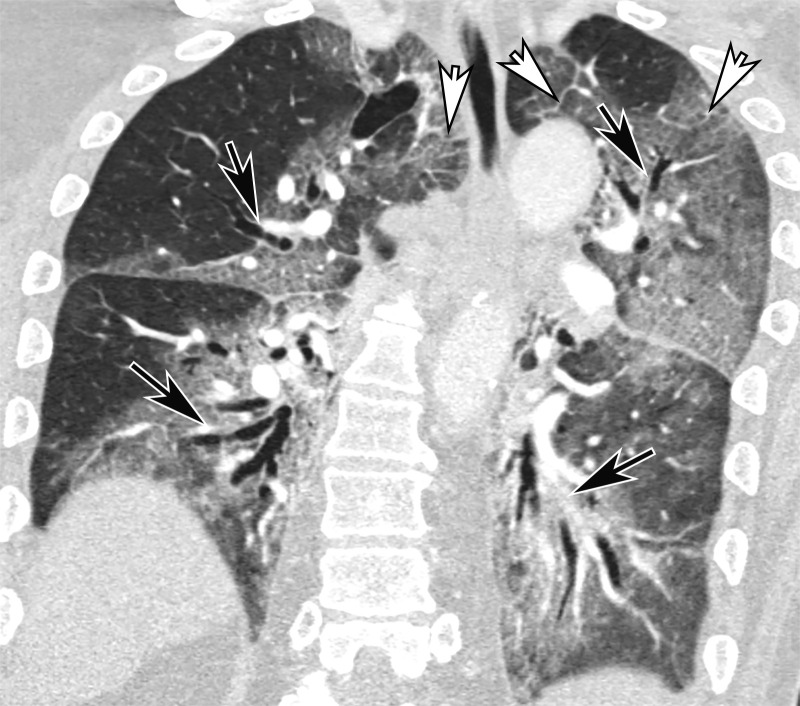 Bronchial dilatation in an 83-year-old man with COVID-19 with persistent hypoxia and a sudden increase in d-dimer levels, findings concerning for PE. Coronal CT angiographic image shows extensive bilateral bronchial dilatation with bronchial wall thickening (black arrows) and bilateral diffuse posterior lung GGOs, as well as interlobular septal thickening (white arrows), greater on the left than on the right, consistent with the later stages of COVID-19 pneumonia.