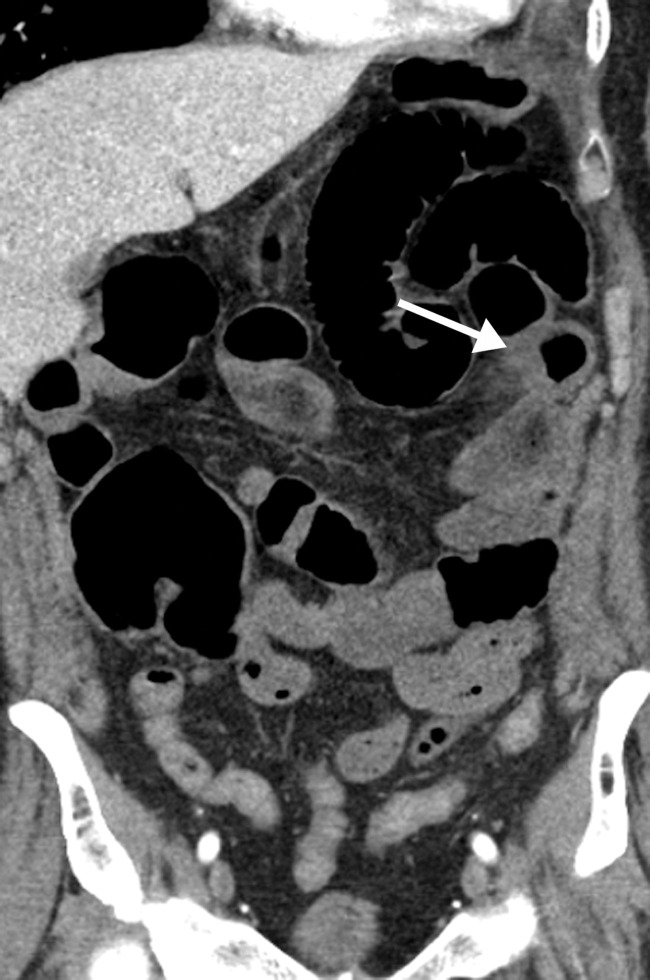 Central and peripheral arterial thrombosis in a severely ill 46-year-old man with COVID-19 in the ICU. (a, b) Axial (a) and sagittal (b) chest CT angiographic images show bibasilar areas of consolidation (black arrows in a), indicative of COVID-19 pneumonia, and a central aortic thrombosis with a thrombus attached to the wall of the aortic arch (white arrow in a and b). (c–f) Sagittal (c), coronal (d), and axial (e, f) CT angiographic images show a large thrombus extending from the abdominal aorta into the superior mesenteric artery origin (arrow in c), which resulted in bowel ischemia, evidenced by thickening of the watershed splenic flexure of the large bowel (arrow in d). Note the multifocal bilateral wedge-shaped renal cortical infarcts (arrows in e). Note also a nonocclusive thrombus in the left profunda femoris artery (white arrow in f), indicative of a concurrent presence of a peripheral thrombosis. There is normal opacification of the patent right profunda femoris artery (black arrow in f). This case demonstrates multifocal multisystem manifestations of COVID-19 complicated by coagulopathy that resulted in injury to various organs and systems. It is an example of the need for increased awareness among radiologists to thoroughly evaluate all covered anatomy for COVID-related complications.