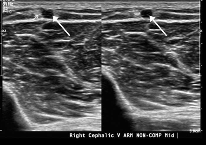 Extensive bilateral upper extremity DVT in a critically ill 77-year-old man with COVID-19 who developed bilateral upper extremity swelling, with markedly elevated d-dimer levels (31 447 ng/mL). (a, b) Sagittal color (a) and power (b) Doppler US images show absent flow in the distended vein, with echogenic material in the left subclavian vein (arrow in a) and the right axillary vein (arrows in b), compatible with bilateral occlusive thrombi. Additional occlusive and nonocclusive thrombi were also seen (not shown). (c) Gray-scale US images without (left) and with (right) compression show a thrombus (arrows) in the right cephalic vein, which demonstrates no vascular compression (arrows).