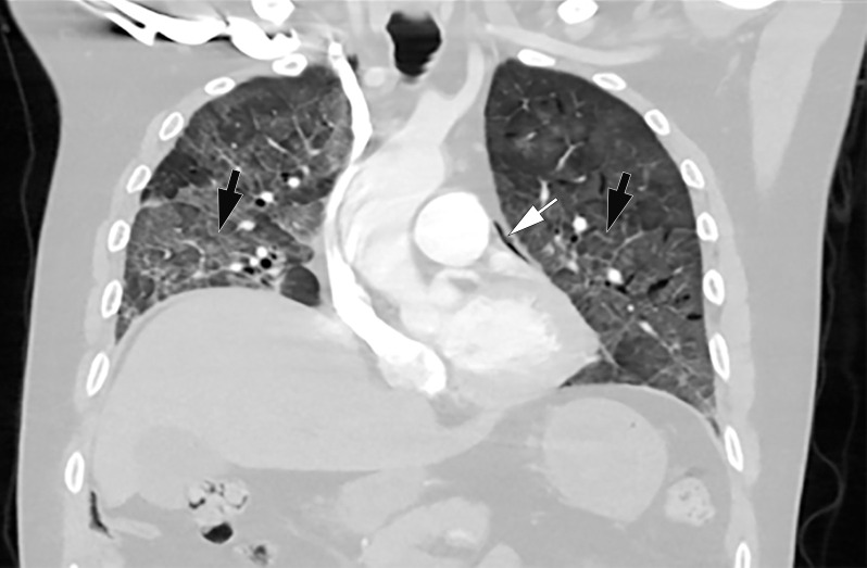 COVID-19 complicated by pneumomediastinum in a 61-year-old man. Axial (a) and coronal (b) chest CT angiographic images show a typical appearance of COVID-19 pneumonia, including diffuse GGOs and interlobular septal thickening (black arrows). Air is depicted anterior to the pulmonary artery (white arrow in a) and adjacent to the main pulmonary artery and left atrial appendage (white arrow in b), indicative of pneumomediastinum.