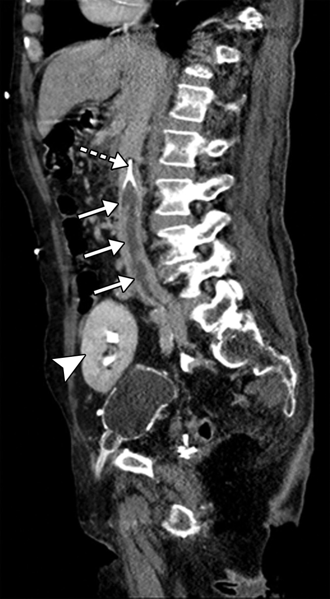 Inferior vena cava (IVC) and peripheral deep vein thrombosis in a 78-year-old man with COVID-19 with leg swelling and abdominal pain. Sagittal (a) and axial (b) contrast-enhanced CT images show filling defects in the bilateral common femoral veins (solid arrows). Near complete occlusion of the IVC (solid arrows in a) to the level of an IVC filter (dashed arrow in a) was present. Note the renal transplant (arrowhead in a). Both central and peripheral venous thrombosis were not depicted at prior imaging examinations (not shown).