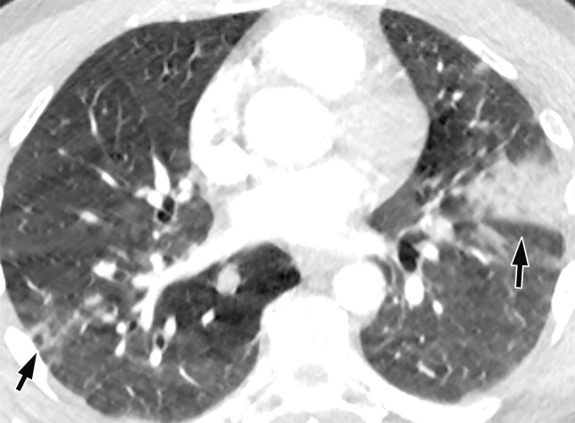 Saddle embolus in a 52-year-old man who presented to the emergency department with hypoxia and tachycardia and received positive test results for COVID-19. (a–c) Axial chest CT angiographic images show a saddle embolus (arrows in a), extending into the lobar and segmental pulmonary artery branches bilaterally, and associated dilatation of the right ventricle, suggestive of right heart strain (arrow in b). Patchy peripheral GGOs on the right and a nodular area of consolidation (arrows in c) on the left are typical findings of COVID-19 pneumonia. (d) Gray-scale (left) and corresponding color Doppler (right) US images of the left femoral vein (FV) obtained in the transverse plane show a partially occlusive thrombus (arrows). The vein was not compressible at manual compression (not shown).