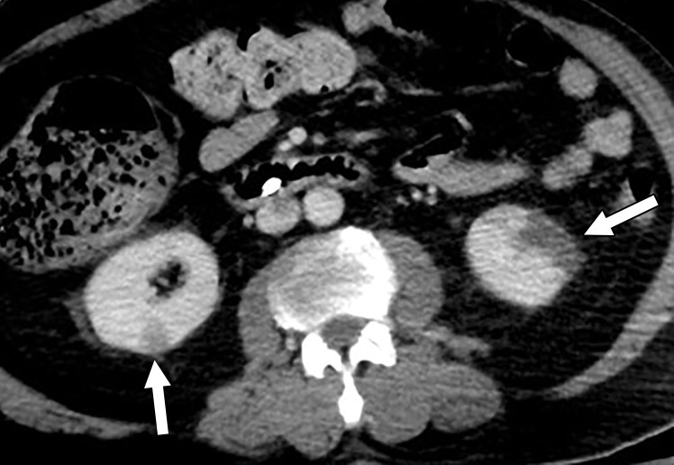 Central and peripheral arterial thrombosis in a severely ill 46-year-old man with COVID-19 in the ICU. (a, b) Axial (a) and sagittal (b) chest CT angiographic images show bibasilar areas of consolidation (black arrows in a), indicative of COVID-19 pneumonia, and a central aortic thrombosis with a thrombus attached to the wall of the aortic arch (white arrow in a and b). (c–f) Sagittal (c), coronal (d), and axial (e, f) CT angiographic images show a large thrombus extending from the abdominal aorta into the superior mesenteric artery origin (arrow in c), which resulted in bowel ischemia, evidenced by thickening of the watershed splenic flexure of the large bowel (arrow in d). Note the multifocal bilateral wedge-shaped renal cortical infarcts (arrows in e). Note also a nonocclusive thrombus in the left profunda femoris artery (white arrow in f), indicative of a concurrent presence of a peripheral thrombosis. There is normal opacification of the patent right profunda femoris artery (black arrow in f). This case demonstrates multifocal multisystem manifestations of COVID-19 complicated by coagulopathy that resulted in injury to various organs and systems. It is an example of the need for increased awareness among radiologists to thoroughly evaluate all covered anatomy for COVID-related complications.