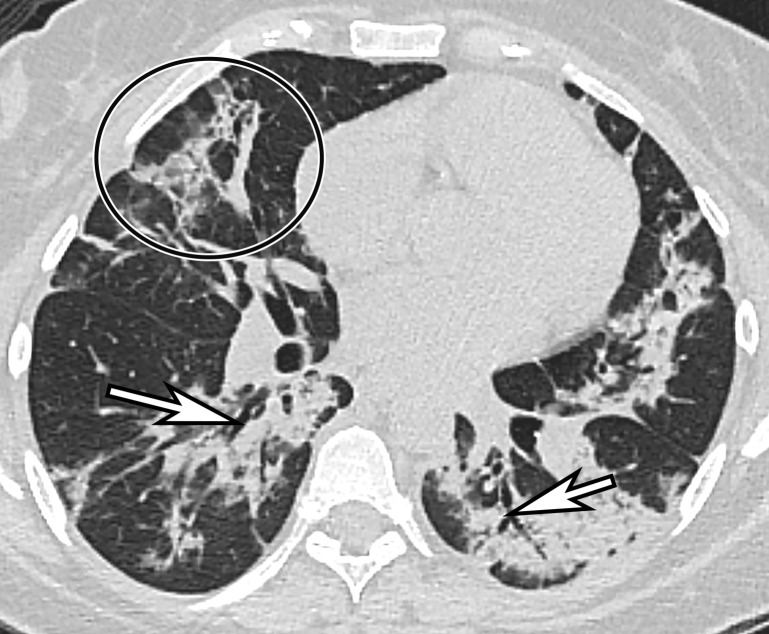 Temporal pulmonary changes of COVID-19 pneumonia at CT in a 36-year-old woman. (a–c) Axial contrast-enhanced CT images obtained at hospital admission show patchy bilateral GGOs and interlobular septal thickening (black arrows), with lower lobe predominance and subpleural involvement. Note also some immediate subpleural sparing of the GGOs (white arrows in b and c). (d–f) Follow-up corresponding axial contrast-enhanced CT images show evolving consolidative changes with volume loss, architectural distortion (ovals), and bronchiectasis (arrows in e and f).