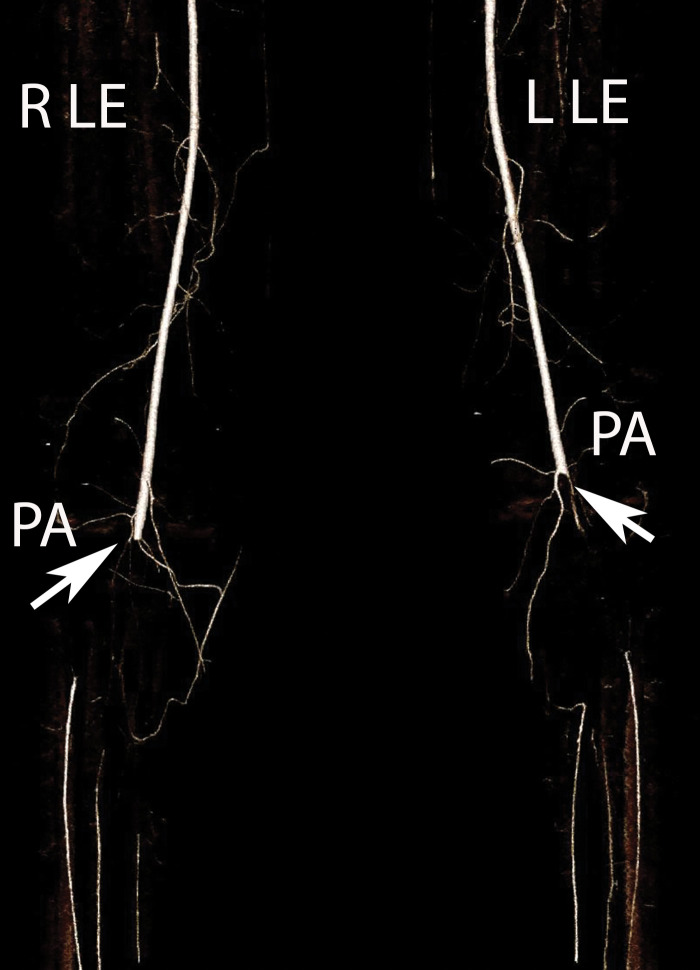 Popliteal artery occlusion in a severely ill 65-year-old man with COVID-19 with bilateral diminished dorsalis pedis pulses. Coronal three-dimensional volume-rendered run-off CT angiographic image shows abrupt cutoff (arrows) of the bilateral popliteal arteries (PA), compatible with bilateral occlusion. Note that distally run-off calf arteries have been reconstituted through collateral arteries. R LE = right lower extremity, L LE = left lower extremity.