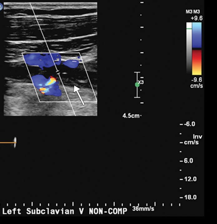 Extensive bilateral upper extremity DVT in a critically ill 77-year-old man with COVID-19 who developed bilateral upper extremity swelling, with markedly elevated d-dimer levels (31 447 ng/mL). (a, b) Sagittal color (a) and power (b) Doppler US images show absent flow in the distended vein, with echogenic material in the left subclavian vein (arrow in a) and the right axillary vein (arrows in b), compatible with bilateral occlusive thrombi. Additional occlusive and nonocclusive thrombi were also seen (not shown). (c) Gray-scale US images without (left) and with (right) compression show a thrombus (arrows) in the right cephalic vein, which demonstrates no vascular compression (arrows).