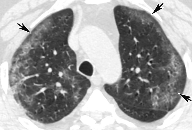 GGOs and subpleural sparing in a 68-year-old man with COVID-19 and difficulty breathing. Axial contrast-enhanced CT image shows bilateral diffuse peripheral GGOs with subpleural sparing (arrows).