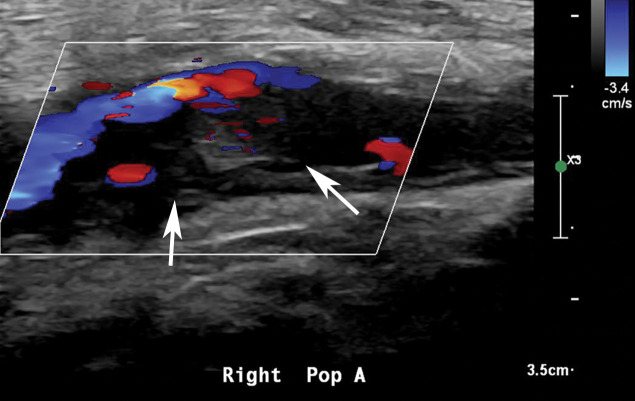 Popliteal and posterior tibial artery thrombosis in a 58-year-old woman with COVID-19 in the ICU. (a, b) Sagittal color (a) and spectral (b) Doppler US images show an echogenic heterogeneous thrombus (white arrows) distending the right popliteal artery. The characteristic knocking or “stump-thump” waveform with absence of diastolic flow (black arrows in b) and low amplitude (yellow circle in b) imply the presence of occlusion just distal to the area of interrogation. (c) Sagittal power Doppler US image shows no flow in the occluded right posterior tibial artery (black arrows). (d) Corresponding sagittal CT angiographic reconstruction shows abrupt cutoff of the popliteal artery by a thrombus (solid arrow). Note the opacified popliteal artery (Rt POP A) proximal to the thrombus (dashed arrow). The patient also had a liver infarct and bowel ischemia (not shown).