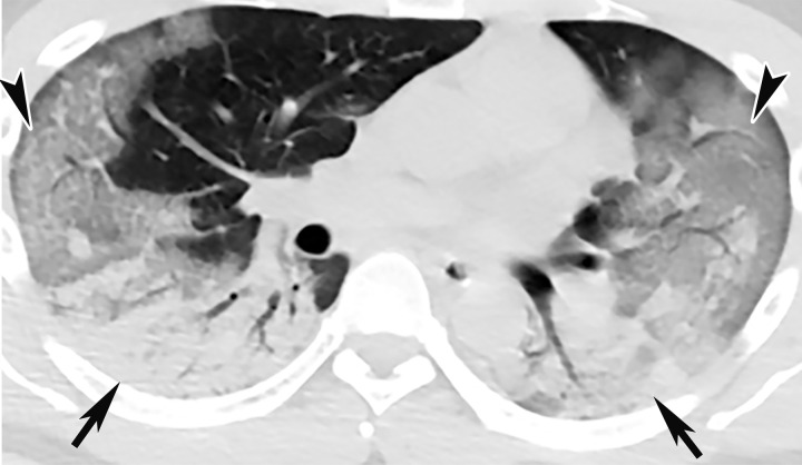 COVID-19 progression over 4 days in a 28-year-old man. (a) Posteroranterior chest radiograph shows bilateral multiple peripheral and lower lobe GGOs (arrows). (b) Axial non–contrast material–enhanced CT image obtained 4 days later shows progression of the typical appearance of COVID pneumonia, manifesting with bilateral GGOs (arrowheads), peripheral on the right and diffuse on the left. In addition, there is rapid worsening of the lung pneumonia, with development of bilateral lower lobe airspace consolidations (arrows).