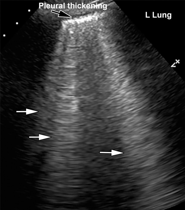 Interstitial edema and pleural thickening in a 40-year-old man with COVID-19 who presented to the emergency department with hypoxia and dyspnea. (a) Gray-scale lung US image obtained in the longitudinal plane over the left lower lobe shows multiple (more than three) vertical echogenic bands (white arrows) extending from the pleural surface to the deeper portions of the lung, consistent with B-line artifacts, indicating subpleural interstitial edema. Note that the lung pleura is thickened and irregular (black arrow). (b) Corresponding AP chest radiograph shows multifocal bilateral patchy peripheral opacities (black arrows), with an area of consolidation (white arrow) in the left lower lobe with air bronchograms, which is indicative of organizing pneumonia.