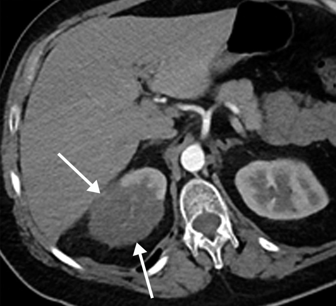 Brachial artery thrombosis and renal infarct in a 51-year-old man who presented to the emergency department with acute left upper extremity pain and numbness. The patient had a 2-week history of cough and fever and was confirmed to be COVID-19 positive. (a) Coronal left upper extremity CT angiographic image shows an abrupt segmental occlusion (arrow) of the distal left brachial artery, indicative of peripheral arterial thromboembolization. The left subclavian and axillary arteries were otherwise unremarkable, with good opacification of the arteries. (b) Coronal three-dimensional maximum intensity projection shows abrupt cutoff (arrow) of the left brachial artery. (c, d) Axial chest CT angiographic images show the typical appearance of lung changes in COVID-19 pneumonia (arrows in c). Note the incidentally found sharp well-defined area of nonenhancement in the partially imaged upper pole of the right kidney, a finding indicative of a renal infarct (arrows in d).