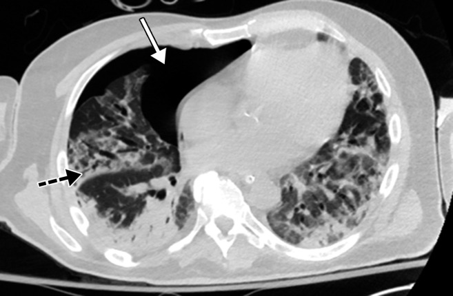 Time course of lung changes in a 59-year-old man with COVID-19 pneumonia evaluated at chest radiography and CT over a 2-month period, which was complicated by development of a pneumothorax. (a–c) AP chest radiographs obtained at hospital admission (a), 4 days later (b), and 1 month later (c) show a peripheral patchy opacity in the left mid lung (oval in a) at the initial assessment, with substantial progression of lung disease on day 4 (b), with development of multiple bilateral peripheral areas of consolidation. The radiograph obtained 1 month later (c) shows interval improvement of the bilateral areas of consolidation and an increase in reticular opacities (dashed arrows in c), with the development of bronchial dilatation (solid arrow in c). Note that at this time the patient had undergone tracheostomy. (d, e) Axial (d) and coronal (e) contrast-enhanced chest CT images, obtained at the same time as c for worsening shortness of breath, show diffuse GGOs associated with superimposed interlobular reticulations, resulting in a crazy-paving pattern (dashed black arrows) and bronchial dilatation (black solid arrows in e). The findings were complicated by the presence of a moderate-sized anterior pneumothorax (white arrows), which was not well appreciated on the plain radiograph (c).