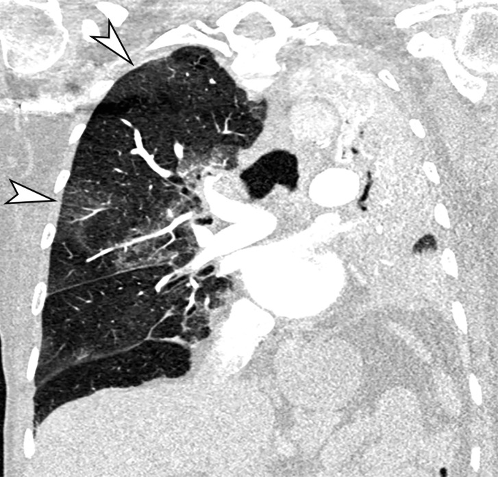 COVID-19 pneumonia complicated by mucus plugging and lung collapse in a 78-year-old man who presented with shortness of breath and suspicion of PE. Axial (a) and coronal (b, c) chest CT angiographic images show patchy GGOs (arrowheads in b) on the right and left lung opacification with volume loss in the left upper lobe due to atelectasis. Adjacent atelectasis and pneumonia in the left upper and lower lobes are evidenced by enhancement of the atelectatic lung (black arrow in c) and absence of enhancement within the pneumonic consolidation (white arrow in c). Atelectasis was caused by the presence of thick mucus that resulted in bronchial obstruction and subsequent collapse.