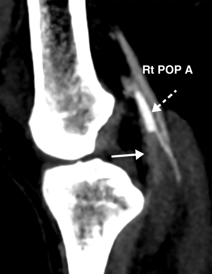 Popliteal and posterior tibial artery thrombosis in a 58-year-old woman with COVID-19 in the ICU. (a, b) Sagittal color (a) and spectral (b) Doppler US images show an echogenic heterogeneous thrombus (white arrows) distending the right popliteal artery. The characteristic knocking or “stump-thump” waveform with absence of diastolic flow (black arrows in b) and low amplitude (yellow circle in b) imply the presence of occlusion just distal to the area of interrogation. (c) Sagittal power Doppler US image shows no flow in the occluded right posterior tibial artery (black arrows). (d) Corresponding sagittal CT angiographic reconstruction shows abrupt cutoff of the popliteal artery by a thrombus (solid arrow). Note the opacified popliteal artery (Rt POP A) proximal to the thrombus (dashed arrow). The patient also had a liver infarct and bowel ischemia (not shown).