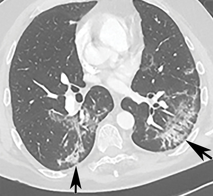 Brachial artery thrombosis and renal infarct in a 51-year-old man who presented to the emergency department with acute left upper extremity pain and numbness. The patient had a 2-week history of cough and fever and was confirmed to be COVID-19 positive. (a) Coronal left upper extremity CT angiographic image shows an abrupt segmental occlusion (arrow) of the distal left brachial artery, indicative of peripheral arterial thromboembolization. The left subclavian and axillary arteries were otherwise unremarkable, with good opacification of the arteries. (b) Coronal three-dimensional maximum intensity projection shows abrupt cutoff (arrow) of the left brachial artery. (c, d) Axial chest CT angiographic images show the typical appearance of lung changes in COVID-19 pneumonia (arrows in c). Note the incidentally found sharp well-defined area of nonenhancement in the partially imaged upper pole of the right kidney, a finding indicative of a renal infarct (arrows in d).